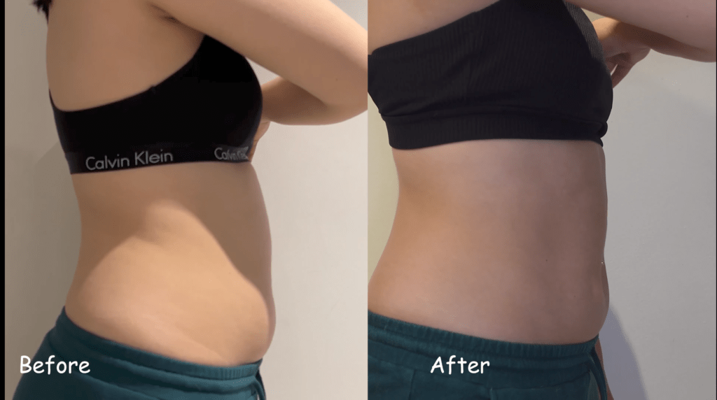 Ideal image coolsculpting reviews before and after by Zoe  Miyoko