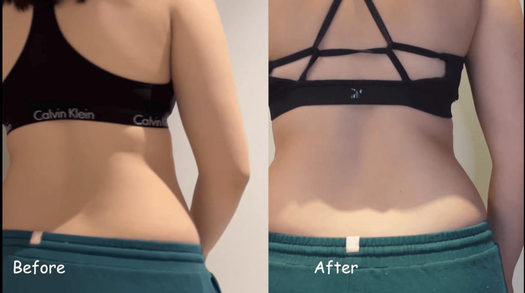 Ideal image coolsculpting reviews before and after by Zoe  Miyoko