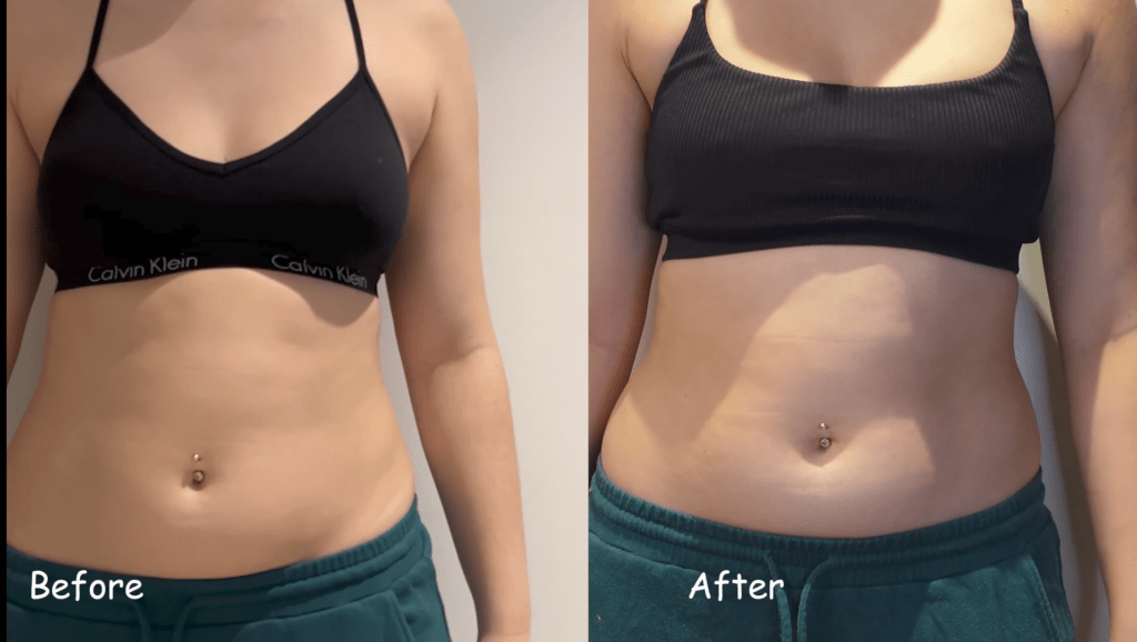 Coolsculpting treatment review before and after ideal image