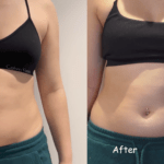 Coolsculpting treatment review before and after ideal image